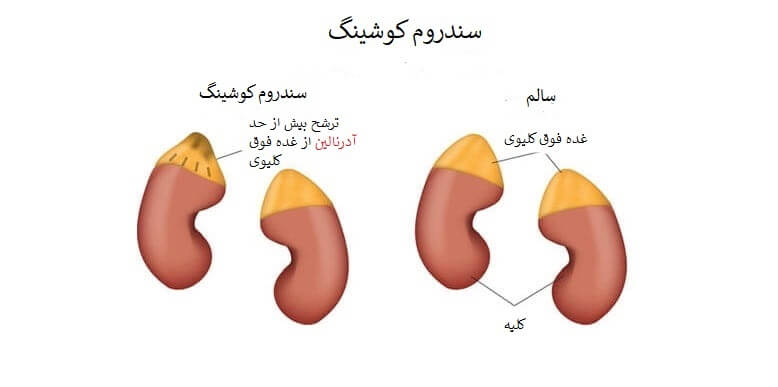 سندروم کوشینگ