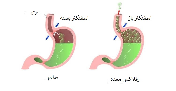 رفلاکس معده