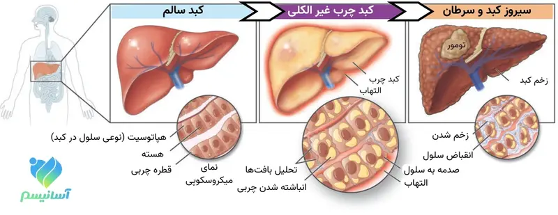 مراحل تخریب کبد در بیماری کبد چرب غیر الکلی