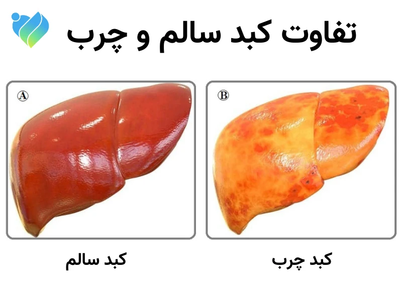 تفاوت کبد سالم با کبد چرب