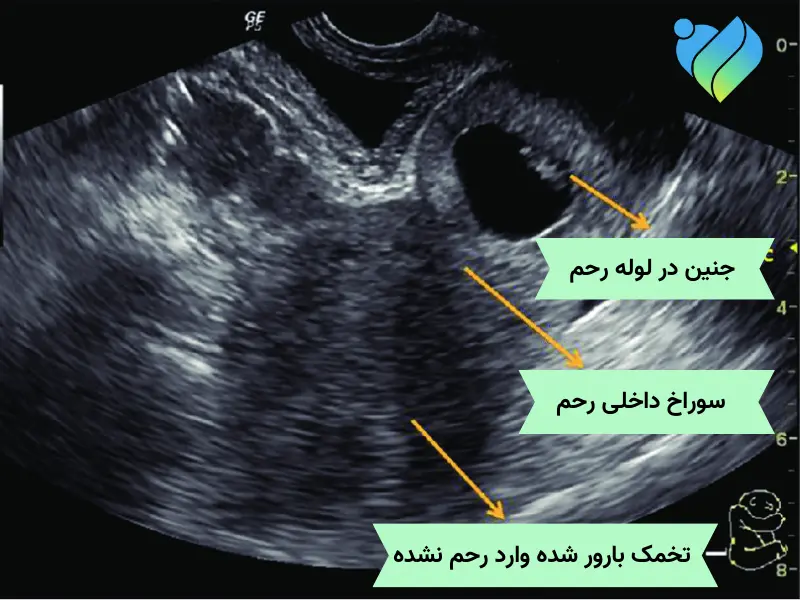 عکس سونوگرافی از مراحل اولیه بارداری خارج از رحم