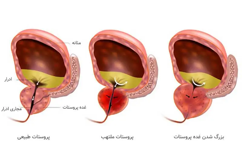 بزرگی پروستات در سنین بالا