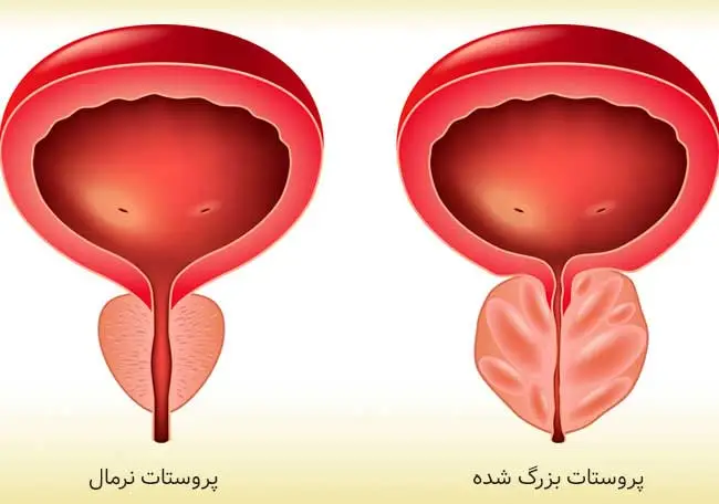 عکس از بزرگی پروستات