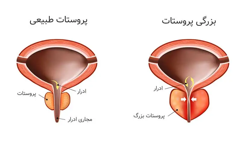 آناتومی بزرگی پروستات سالمندان