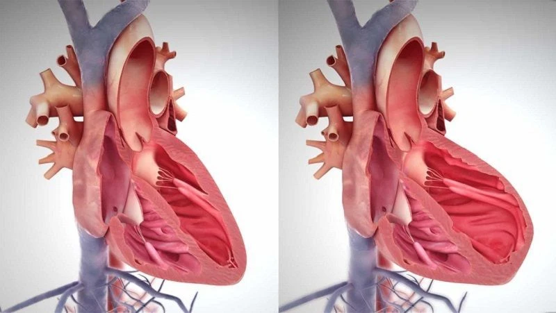 عکس از تفاوت قلب در زمان نارسایی