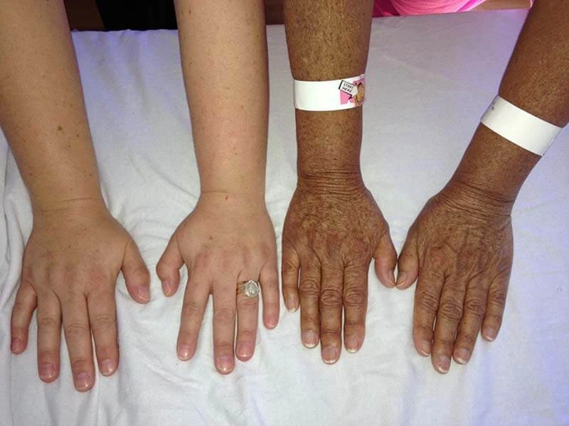 علائم بیماری ادیسون در دست ها