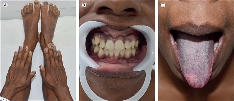 علائم بیماری آدیسون روی زبان، دندان دست ها و پاها