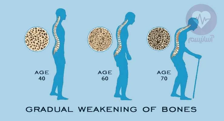 تاثیرات سن روی شدت پوکی استخوان