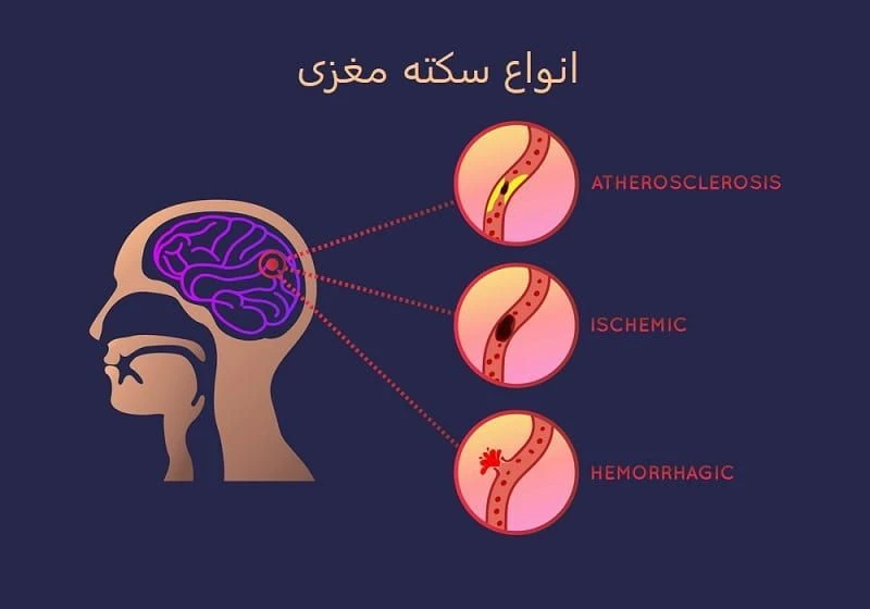 انواع و مدل های مختلف سکته مغزی