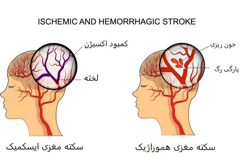 فرق سکته مغزی هموراژیک و اسکمیک