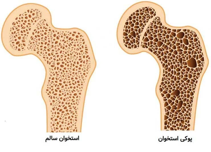 آناتومی پوکی استخوان