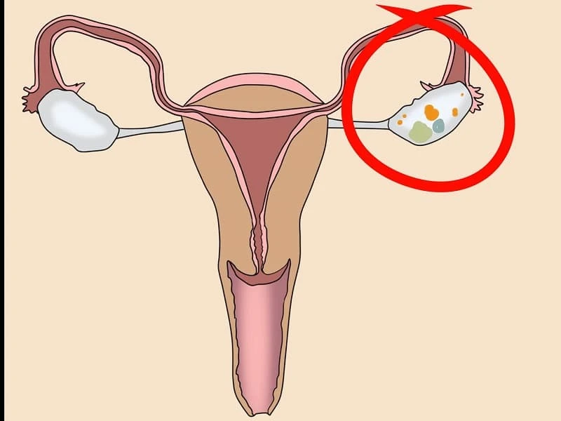 عکس کیست در تخمدان سمت چپ رحم